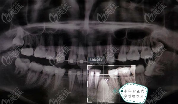 分享一例17岁少年的下颌埋伏牙牵引正畸病例,流程及费用也在其中
