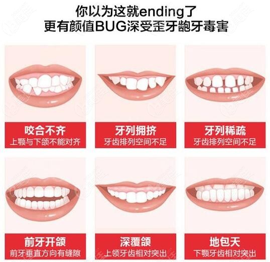 牙齿矫正适应症状