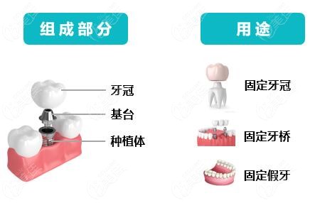 种植牙组成结构