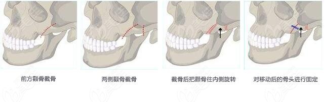 吴国平3D回转颧骨颧弓降低术原理图