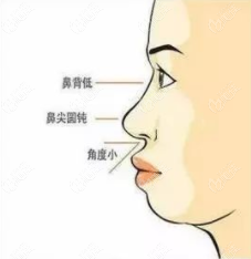 鼻子塌在台州找张龙做隆鼻多少钱