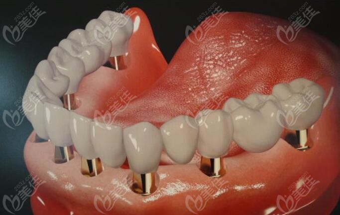 牙齿种植修复