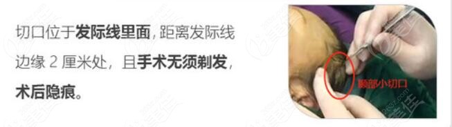 北京高亚东拉皮手术切口示意图片