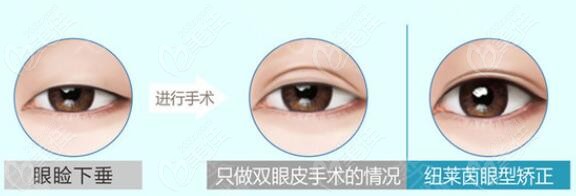 郑在佑医生特色眼型矫正+双眼皮技术