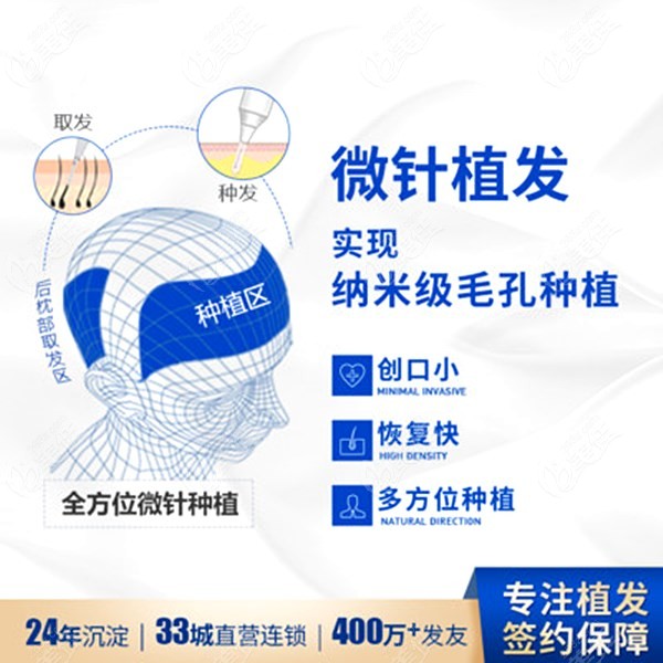 微针植发技术优势介绍