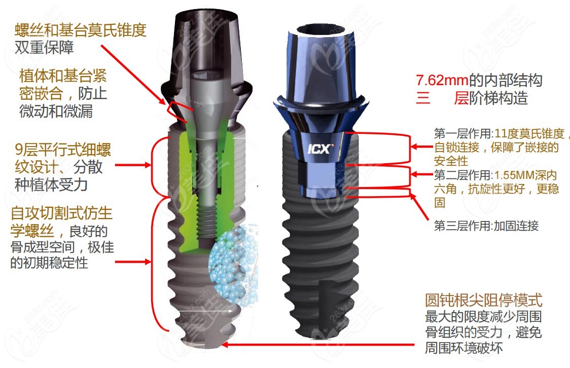 德国icx种植体外观及优点介绍