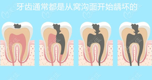 蛀牙龋齿的发展过程