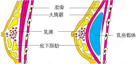 隆胸優勢一:內窺鏡操作技術