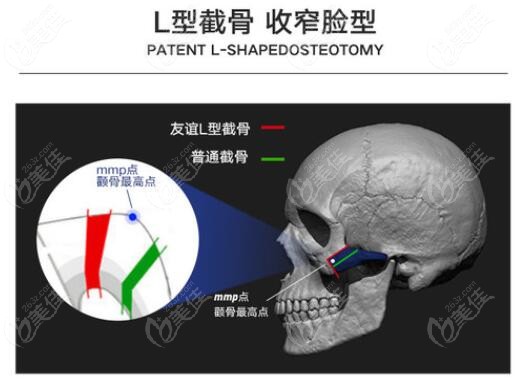 张笑天做颧骨的技术优势