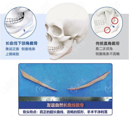 张笑天做下颌角的特色
