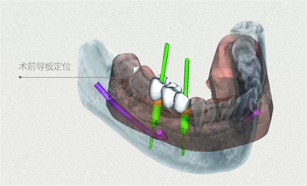 楊丹醫(yī)生在做種植前會進(jìn)行導(dǎo)板定位