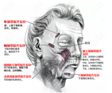 微拉美和拉皮手术哪个好呢？