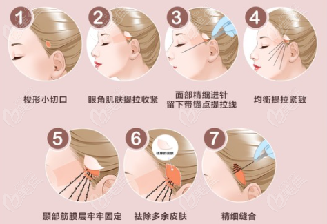 小切口拉皮手术过程示意图
