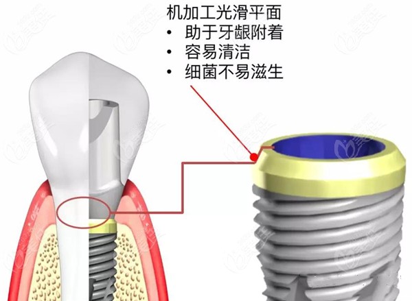 瑞士种植体的价格表