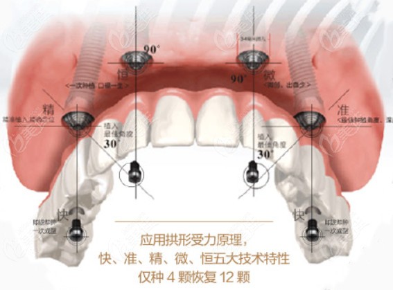 益阳德益口腔的Allon4种植牙技术
