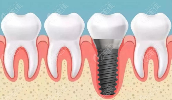 萊蕪種植牙的費(fèi)用參考