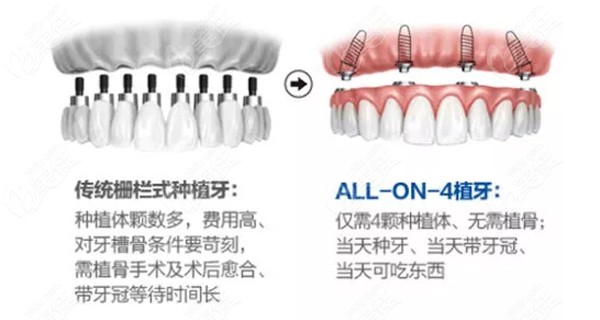 all-on-4种植牙技术优势