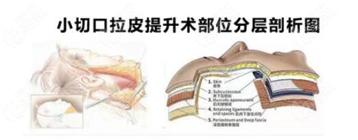 北京黄寺医院小切口拉皮提升术部位分层剖析图