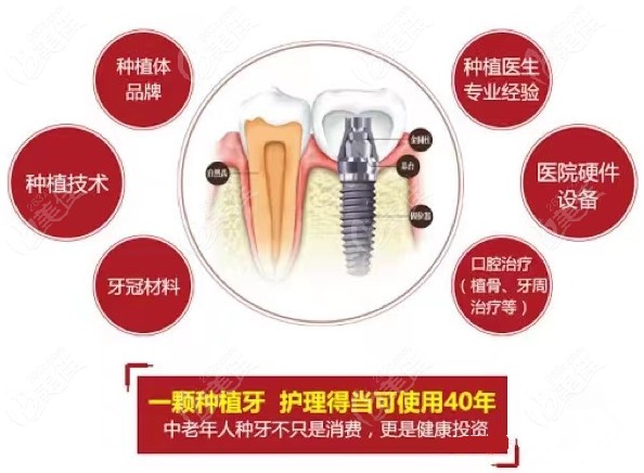 想要种好一颗牙对于医院的选择医生的经验等都比较重要