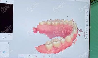 黑科技口掃，1分鐘看正畸結(jié)果