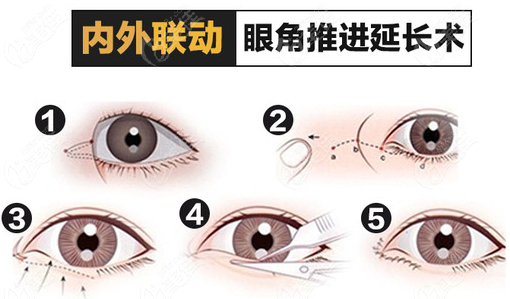 重庆星荣内外联动眼角推进延长术