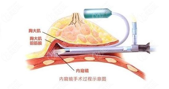 内窥镜隆胸过程示意图