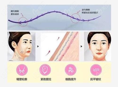 面部埋线提升的原理介绍