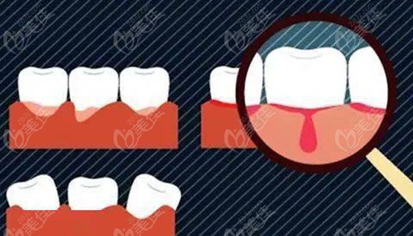 用树脂把龈沟堵住了，导致牙龈发炎