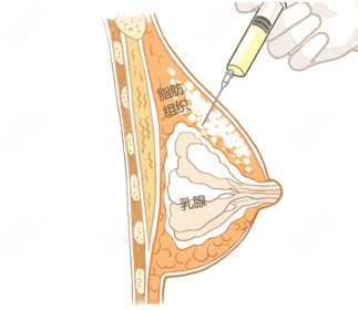 脂肪丰胸示意图图片
