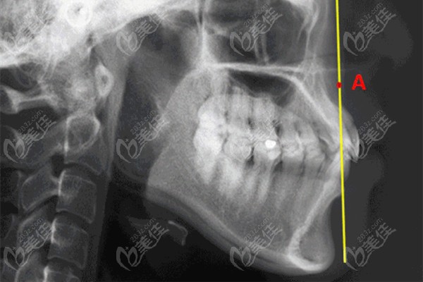 头颅侧位片可以判断牙床前突的程度