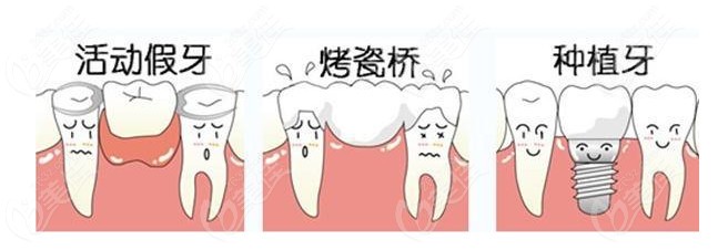 牙齿缺失的修复方法不仅有种植牙