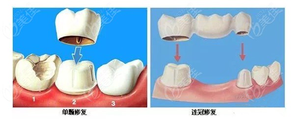 牙齿单颗修复和连冠修复