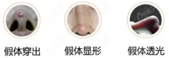 假体透光等示意图