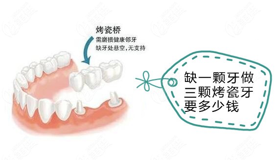 缺一颗牙做三颗烤瓷牙冠要多少钱