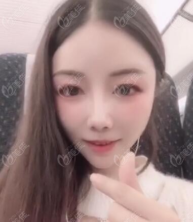 在韩国有名的整形医院做颧骨下颌角+眼鼻整形术后6个月照片分享，真的判若两人！