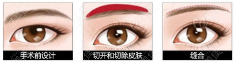 长沙雅美欧提眉手术过程示意图