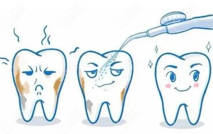 洗牙的必要性