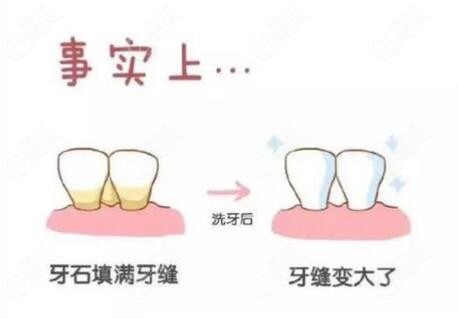 洗牙后牙缝变大了