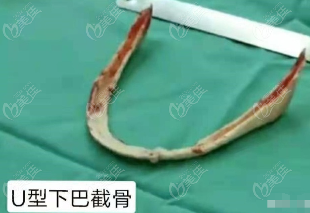 U型下巴截骨
