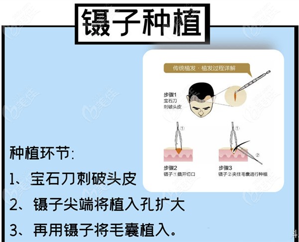 技术特点:fue植发技术比fut隐痕技术创伤小,不留线性疤痕,恢复,价格低