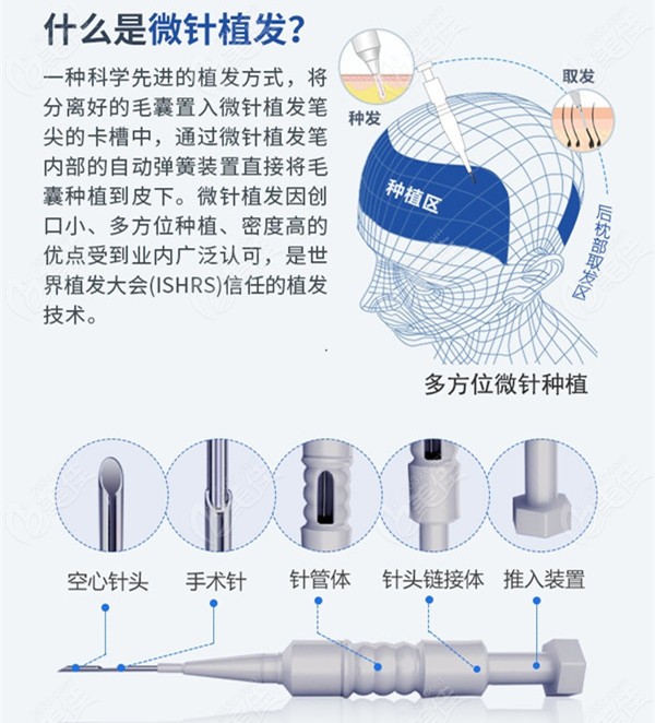 fue无痕植发微针植发和3d植发技术哪个好对比技术特点和价格