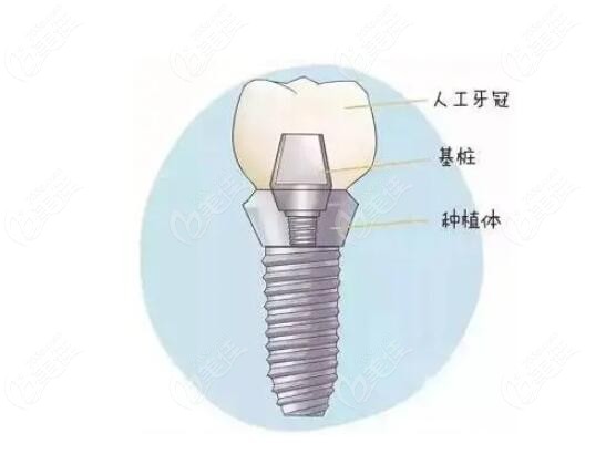 种植假牙的构成