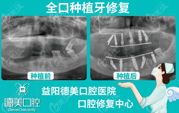 益陽德美口腔的全口種植牙病例