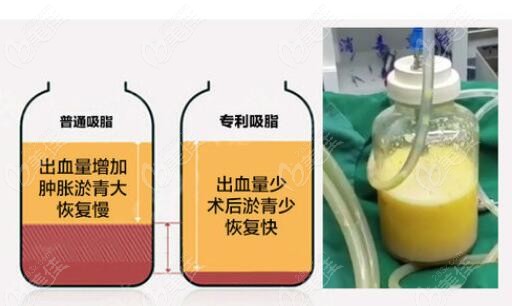 北京新星靓李伟民吸脂特色