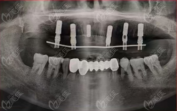 60岁张叔半口牙齿松动通过即拔即种即刻负重种植牙技术当天用牙