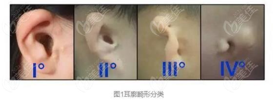 小耳畸形等级分类图片