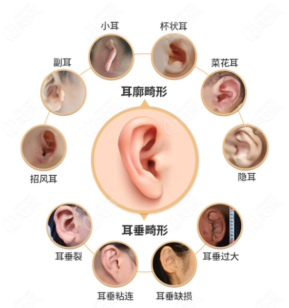 耳朵畸形图片有哪些