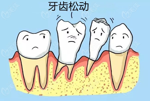 口腔疾病之牙齿松动