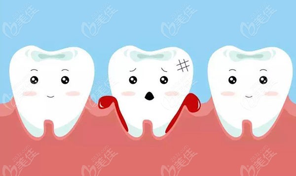 口腔疾病之牙龈炎