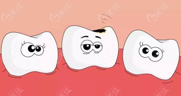 蛀牙龋齿的卡通示意图